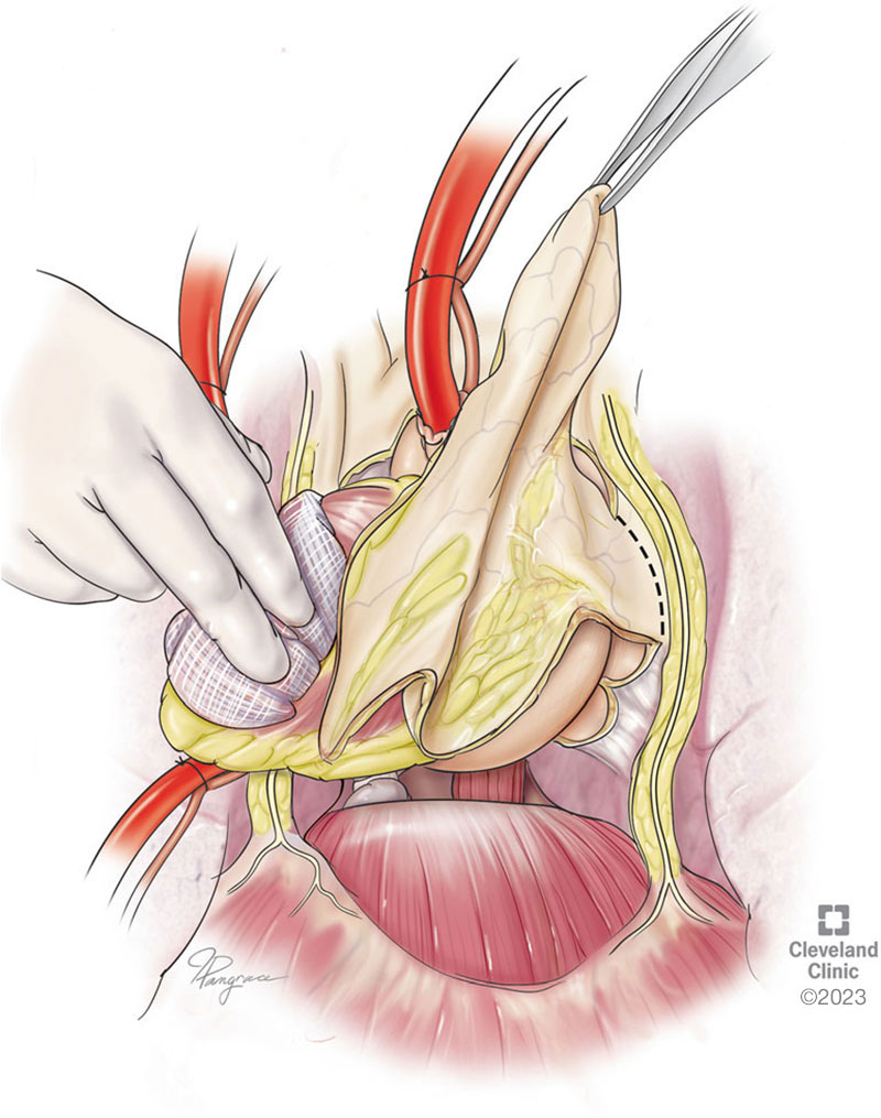 diaphragmatic portion and the posterior pericardium